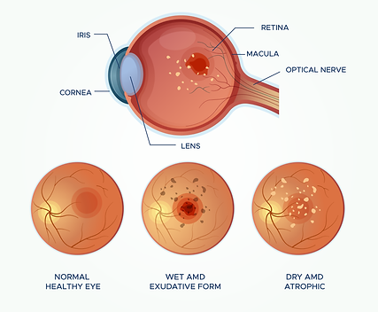 Macula Degeneration