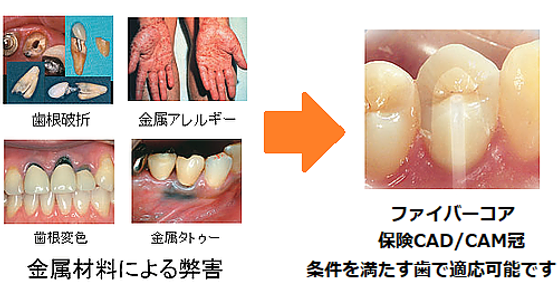 うらた歯科 北海道石狩市花川 保険外のセラミックでも保険の銀歯でも丁寧に