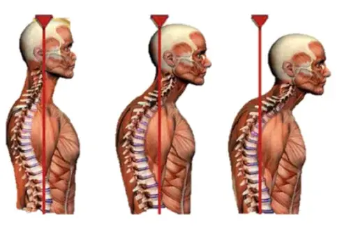 Epaules tombantes posture