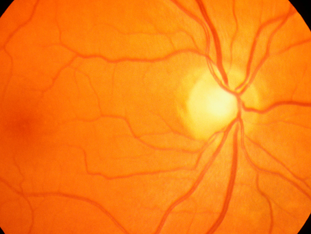 What Is VEGF—and Why Does It Matter in Wet AMD?