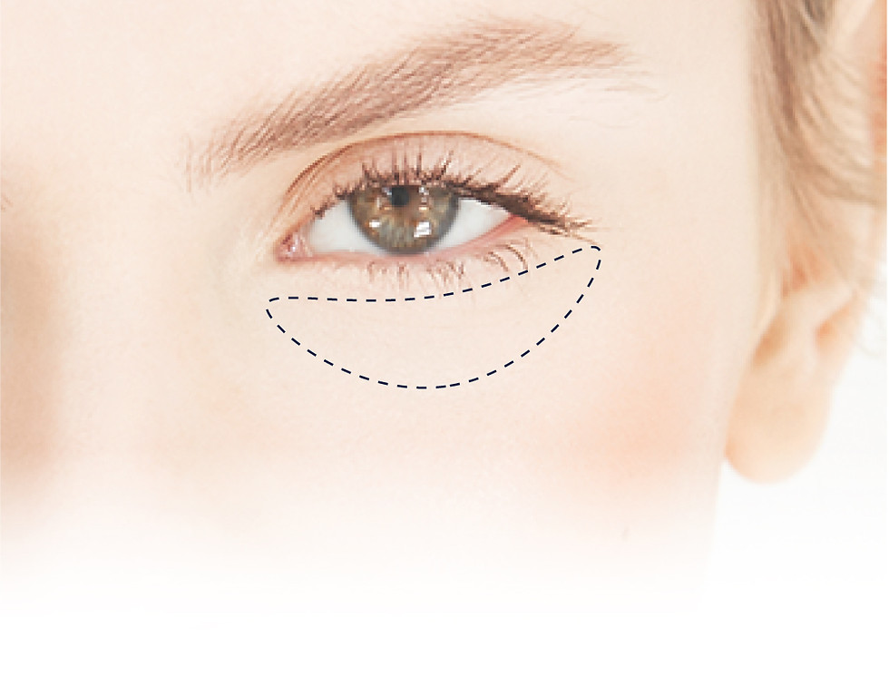 アイバックリムーブ-(目の下の皮膚のたるみとり).jpg