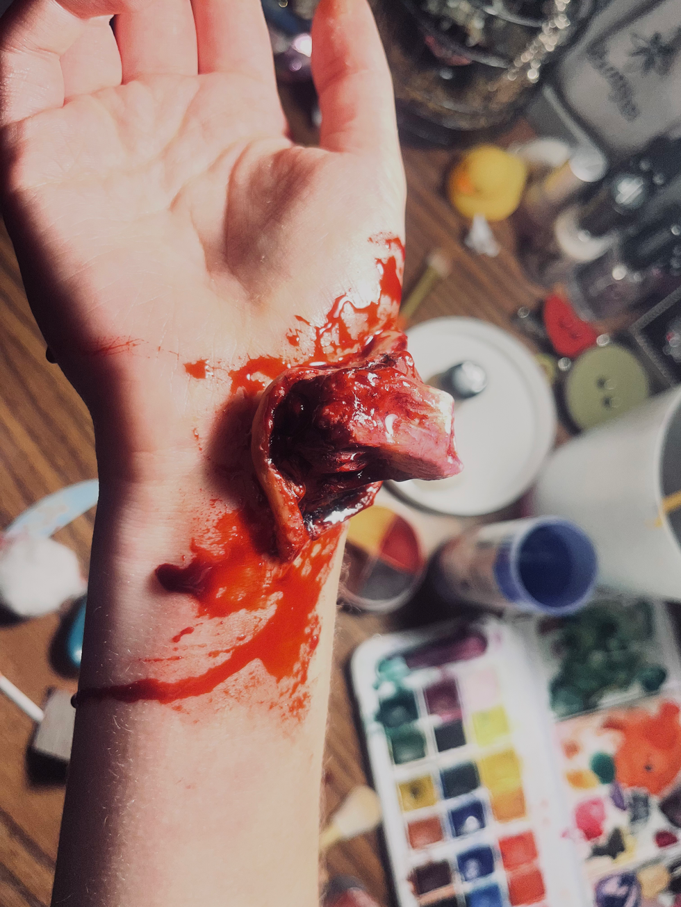 Compound fracture SFX