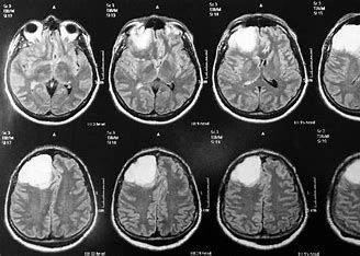 Novo tratamento inibe crescimento de células de tumores cerebrais, diz estudo