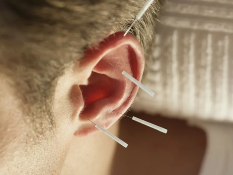 Estudo confirma benefício da acupuntura auricular no tratamento da depressão