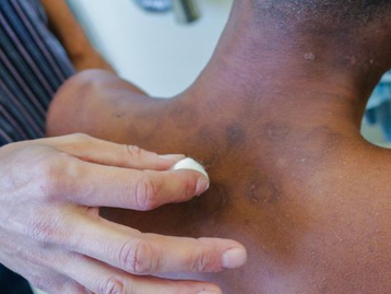 Inteligência artificial pode acelerar diagnóstico de hanseníase