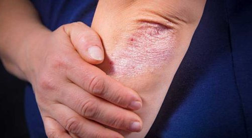 Managing Eczema: Don’t Forget the Basics