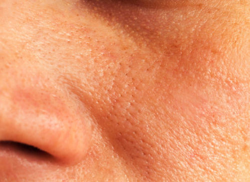 Baumann Skin Type® ORPW: What You Need to Know