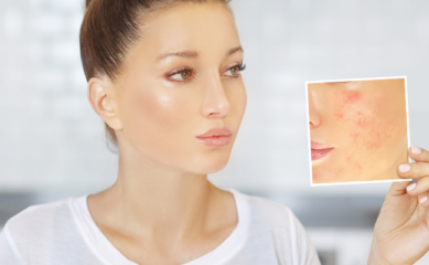 Acne Scars: What Causes Acne Scars and How Do I Prevent Acne Scars?