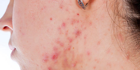 Understanding Acne