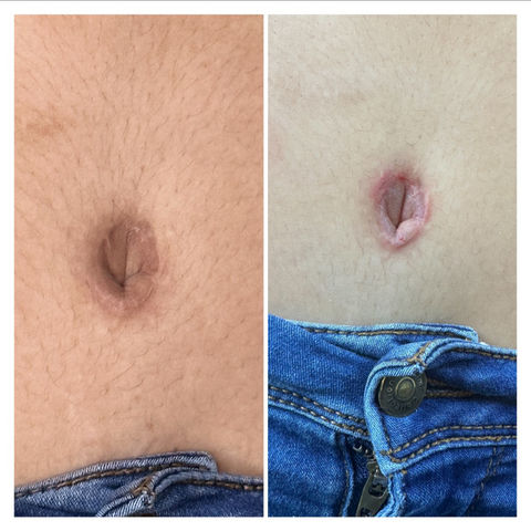Stretch mark camouflage Tampa