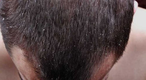 What to Do about Dandruff