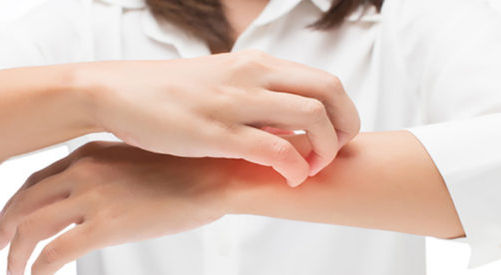 How to Treat Eczema