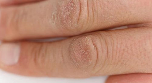 Dry Skin Tips