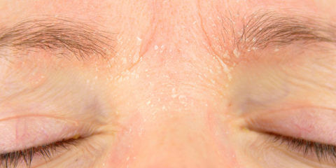 Baumann Skin Type® DSPT: What You Need to Know