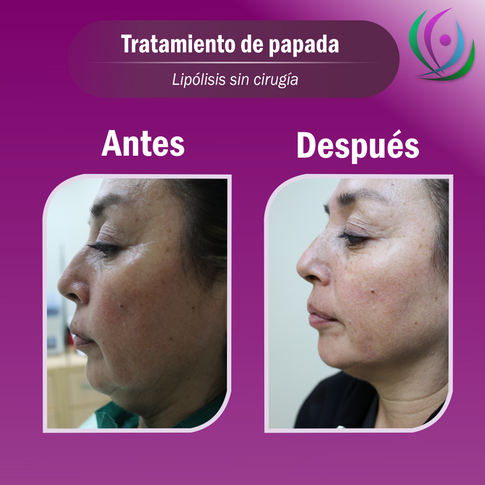MD - Tratamiento de papada (1000px . 100