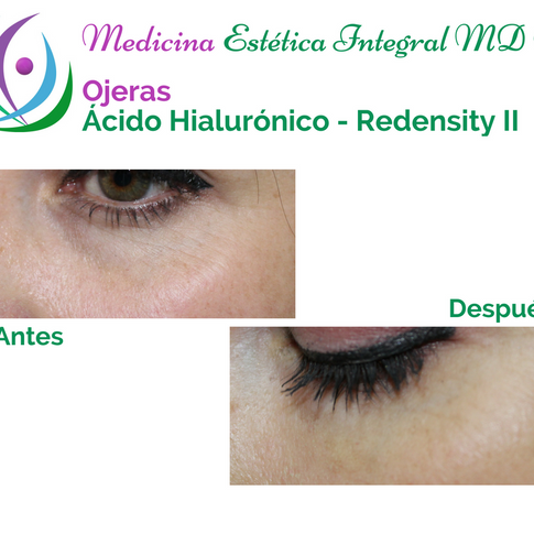 Ojeras 2.png