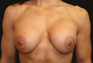 #4 Breast Augmentation After