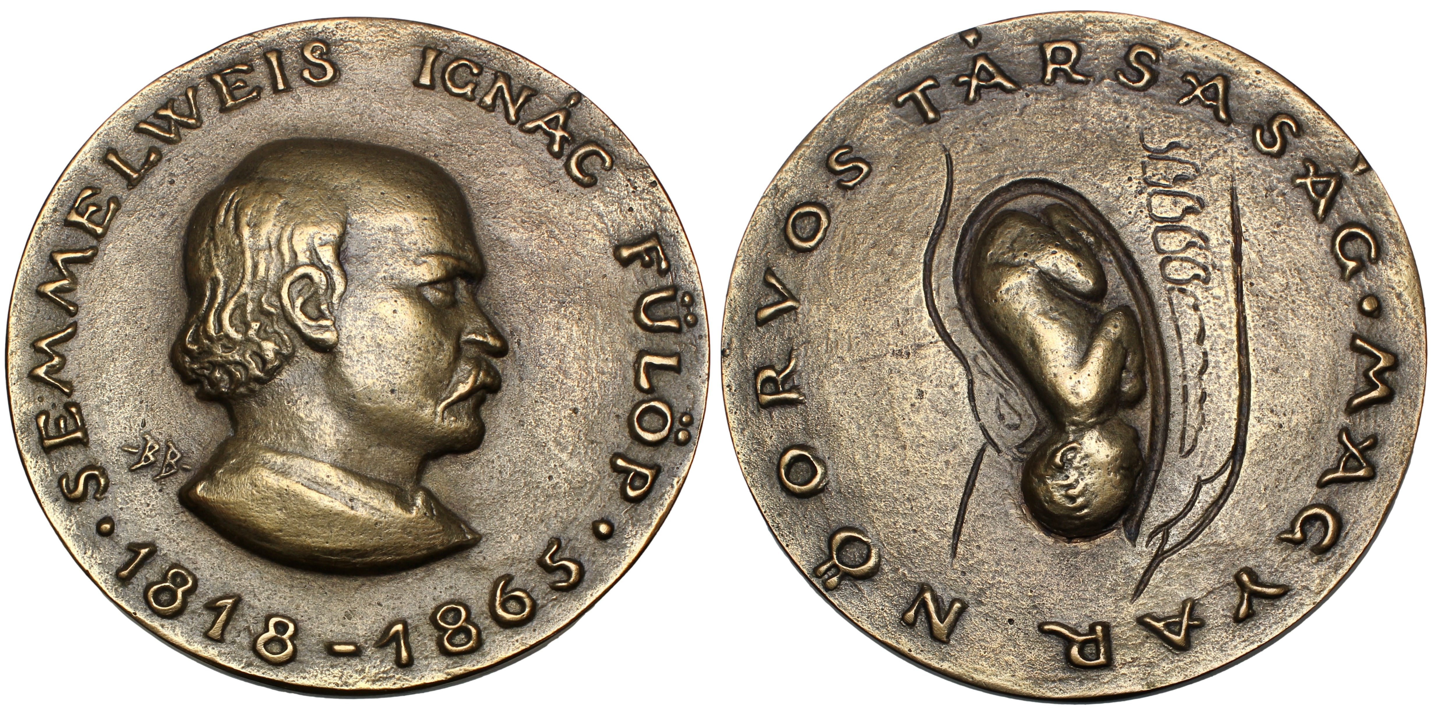102089  |  HUNGARY. Semmelweis Ignác cast bronze Medal.