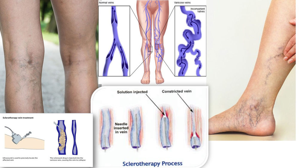 SCLEROTHERAPY A MEDICAL PROCEDURE TO TREAT VARICOSE VEINS