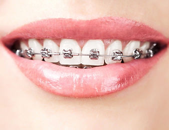 Conventional Metal Braces 2