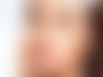 Trẻ hoá da bằng plasma là gì? Nguyên lý hoạt động?