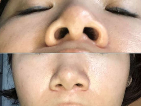 Nâng mũi bị hơi lệch phải làm sao?