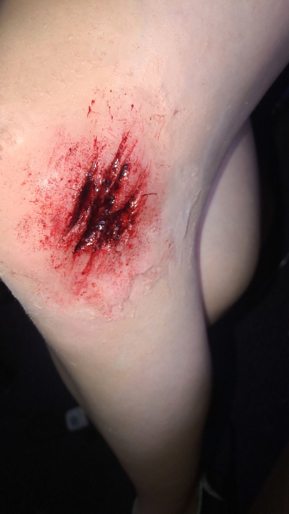 Prosthetic wound