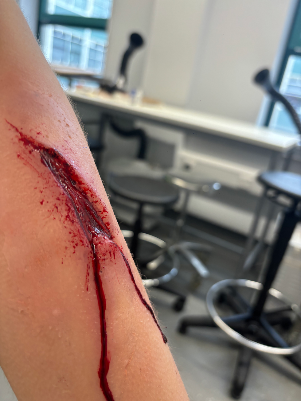 Prosthetic Wound