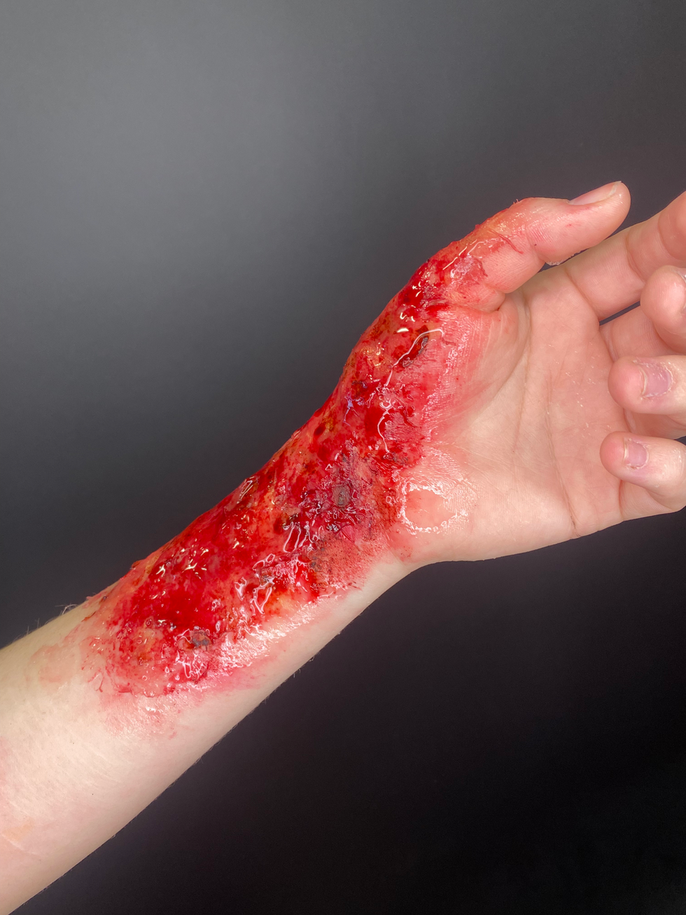 Gelatine Burn