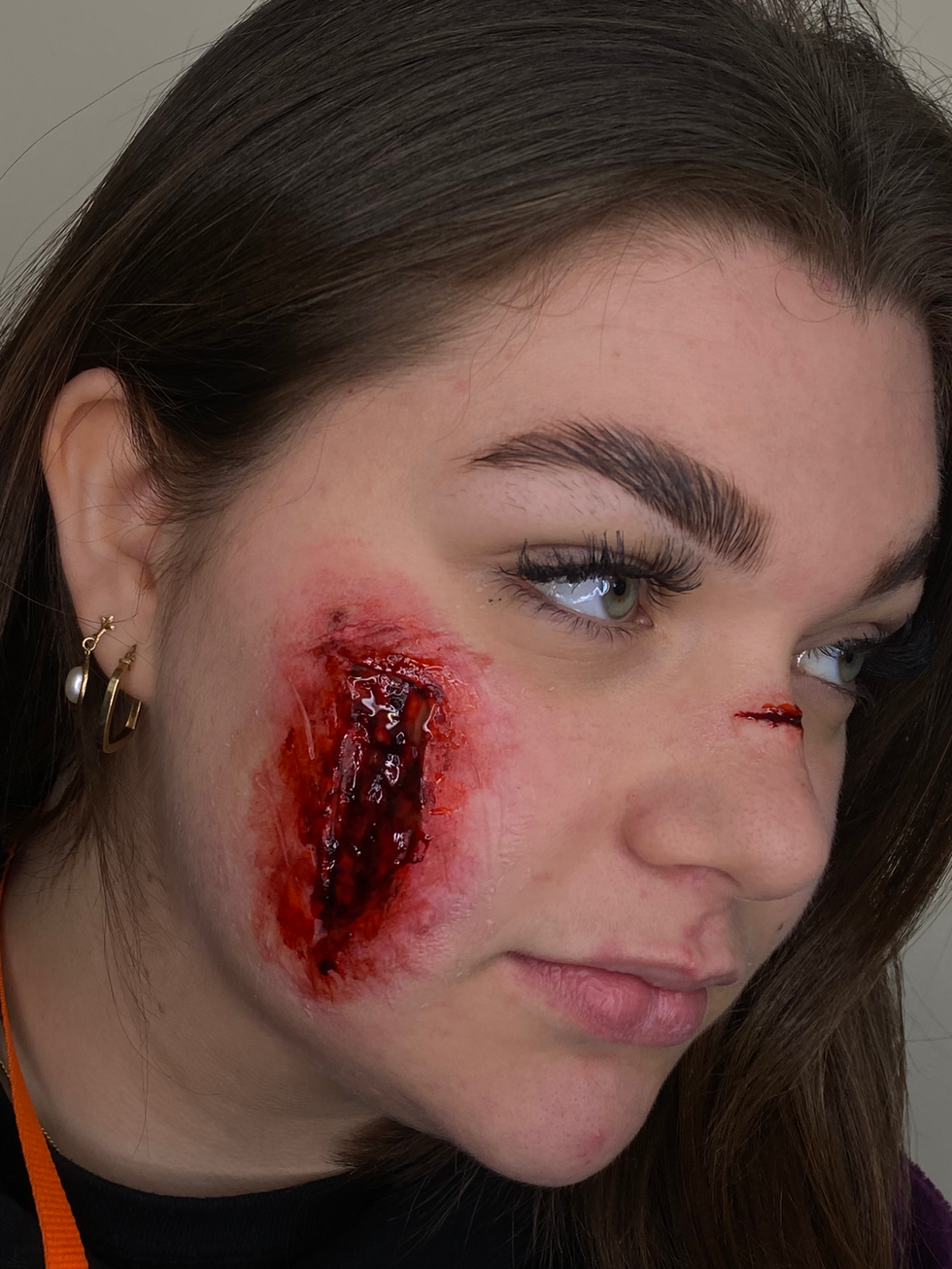 Prosthetic Wound