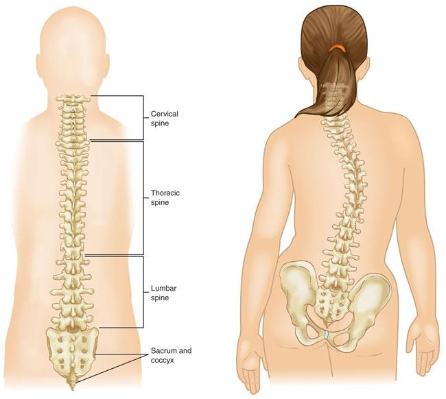 Normal spine vs Scoliotic spine