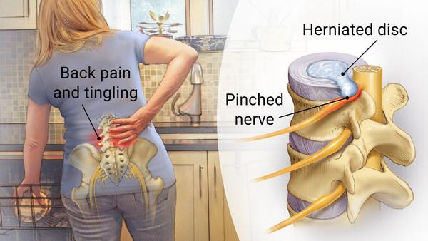 Back Pain and Tingling from Herniated Disc