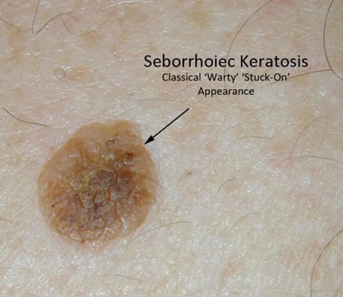Check For Signs Of Skin Cancer Health And Wellbeing Check For Signs Of Skin Cancer Health And Wellbeing