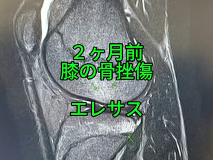 川西市で整体なら ととのえ家 Sanare｜2か月改善しなかった中学生サッカー選手の膝の骨挫傷と早期復帰のポイント
