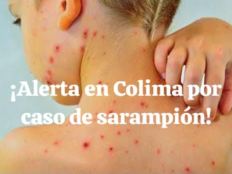 ¡Alerta!, en plena crisis de Salud, se registra primer caso de sarampión en Colima