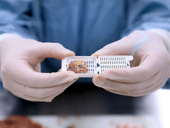 Diagnóstico oportuno y atención multidisciplinaria, claves en el tratamiento exitoso del sarcoma
