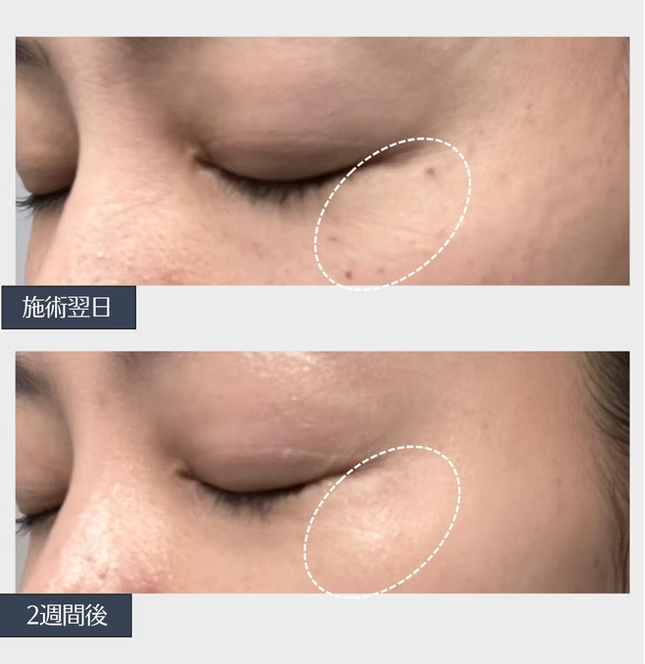 1〜2週間で自然に剥がれ、明るく透明感のある印象に。