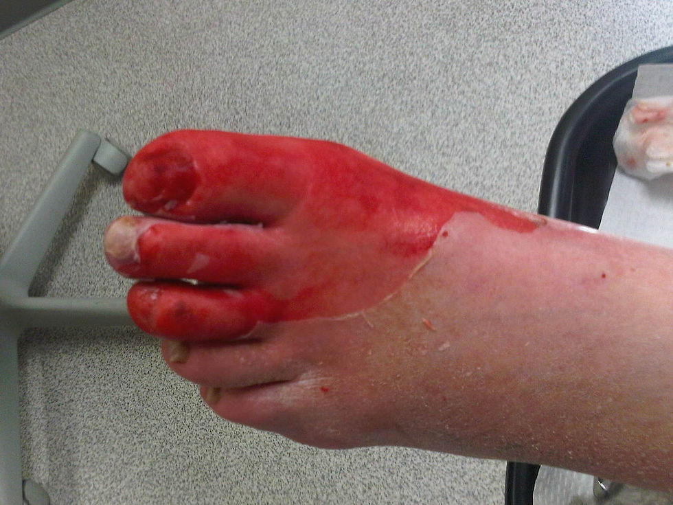 Thermal Burns