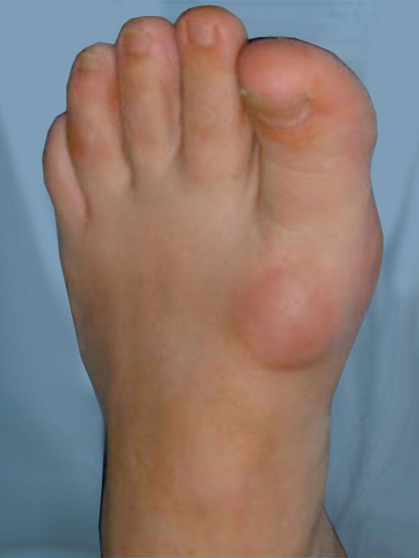 Say NO to BIG TOE fusion