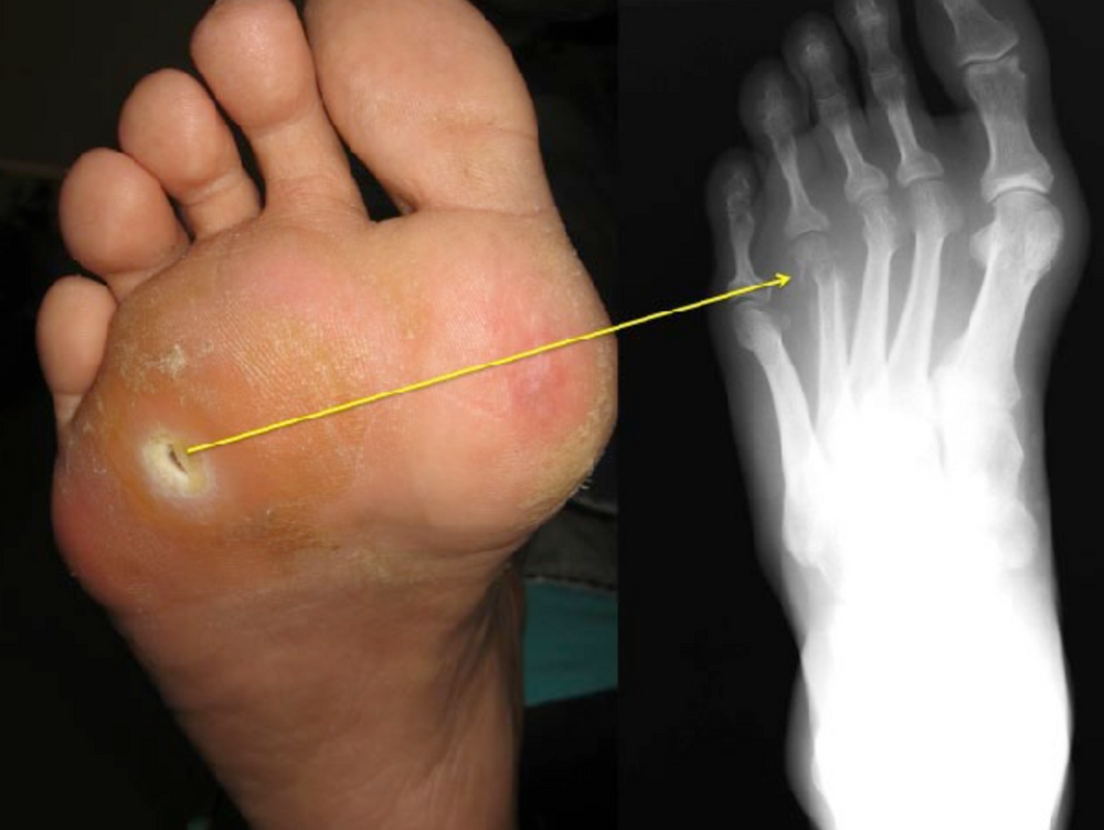 Osteomyelitis of the Foot & Ankle