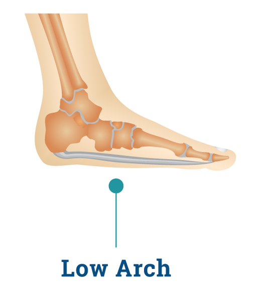 Flatfoot Shoes & Insoles | Dr Martins Foot and Ankle Clinic