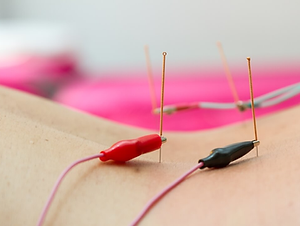Elektrische Akupunktur