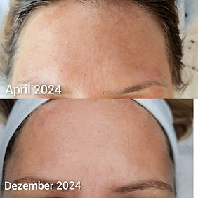 Pigmentflecken heller, BeautyTuningDornbirn