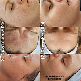 Correktiv Peel, BeautyTuningDornbirn