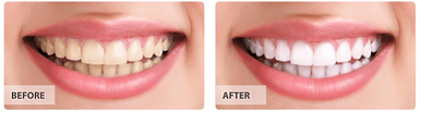 Teeth Whitening - Park Royal Dental - Dr. Payvandi