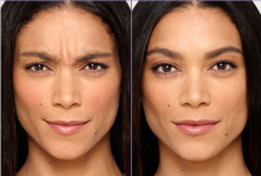 Botox - Park Royal Dental - Dr. Payvandi