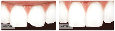 Cosmetic Bonding - Park Royal Dental - Dr. Payvandi