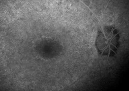 cone dystrophy, floroscein angiography