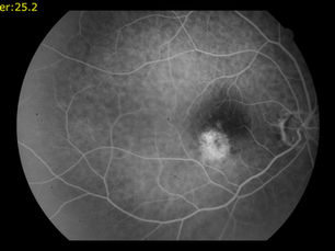 Juxtafoveal Chorodial Neovascular Membrane