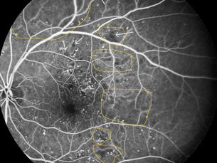 Capillary nonperfusion / capillary drop-out